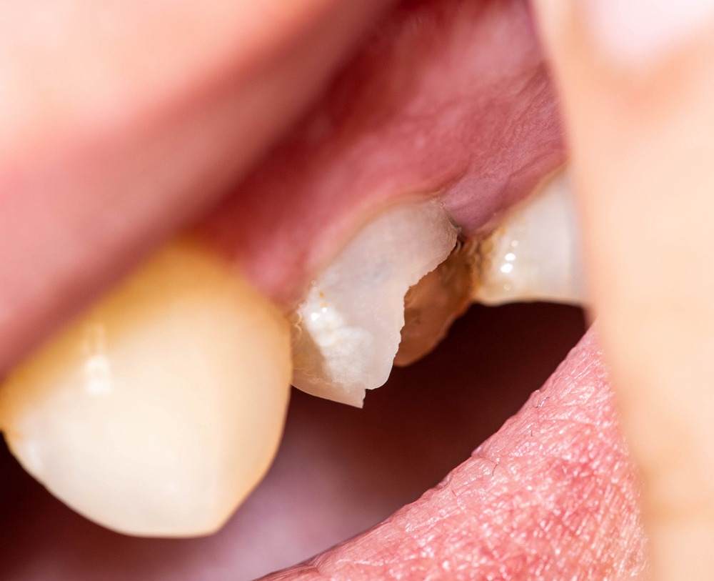 Chipped or Broken Teeth - How To Handle A Dental Emergency?  