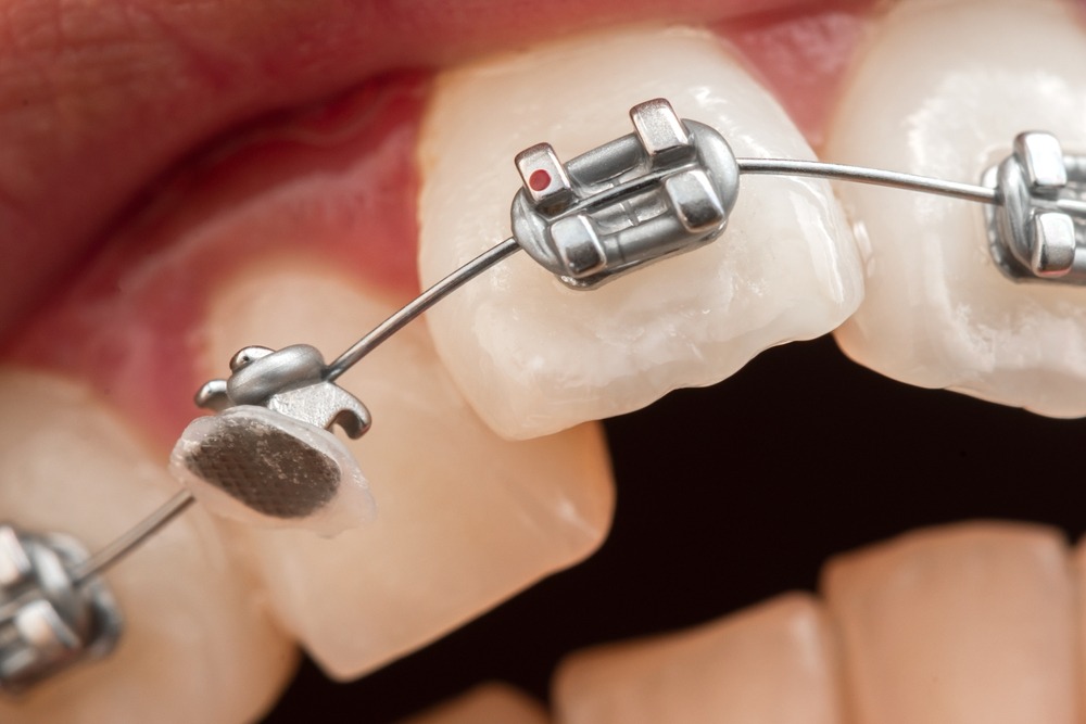 Broken Braces and Wires - How To Handle A Dental Emergency?  